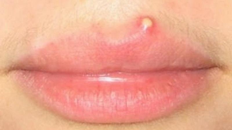 фурункул на губе фото