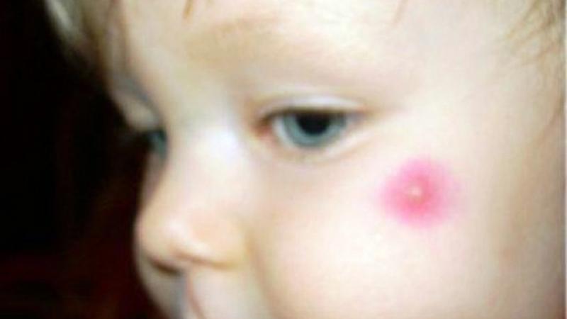 фурункул на щеке лечение