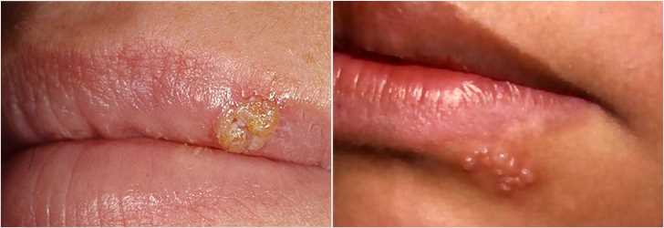 чем лечить герпес во рту фото