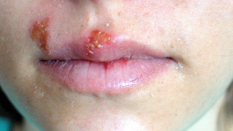 герпес на губах лечение у детей