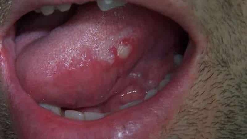 герпес на языке фото лечение