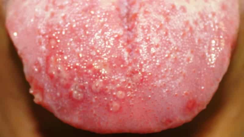 простуда на языке фото