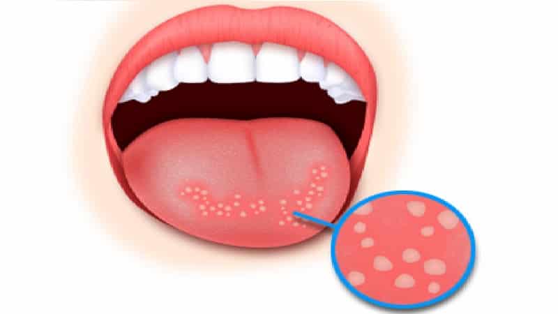 герпес языка фото