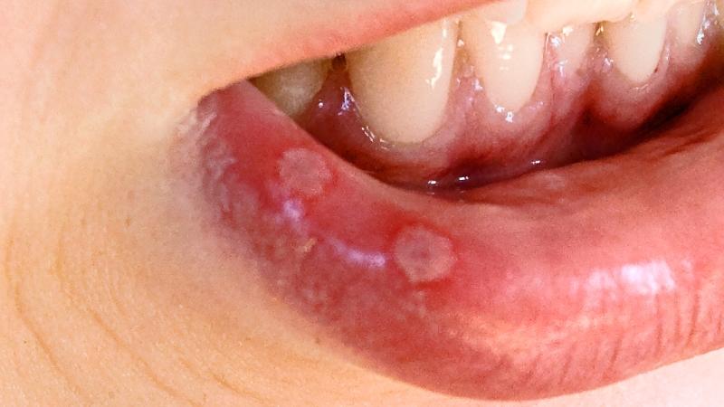 герпетический стоматит у взрослых лечение
