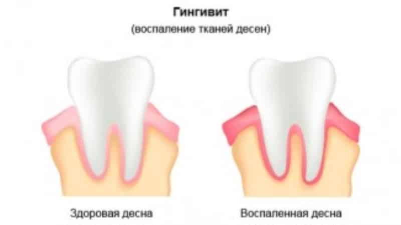 гингивит при беременности лечение