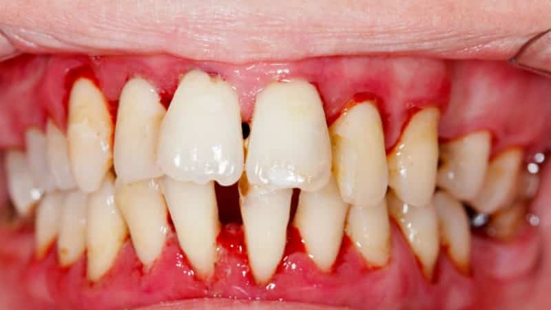 гингивит у беременных лечение