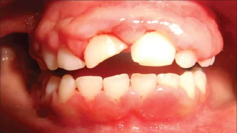 гингивит симптомы и лечение у детей