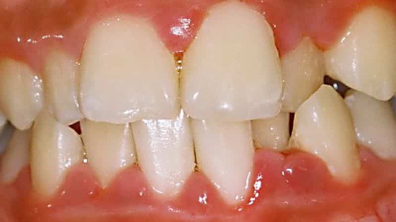 чем лечить гингивит у детей фото