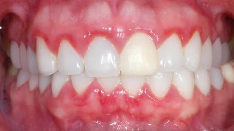 лечение гингивита у детей