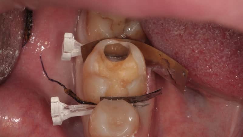 глубокий кариес зубов отличается от острого пульпита