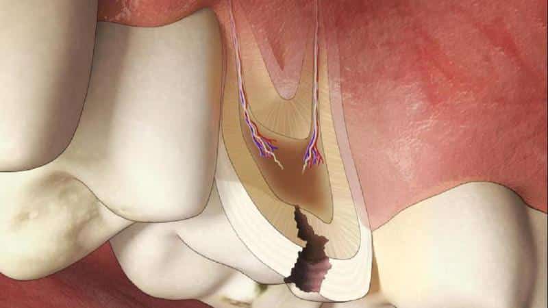 глубокий кариес фото