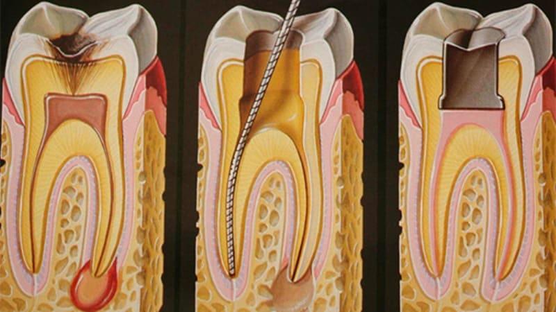 болит зуб после лечения глубокого кариеса