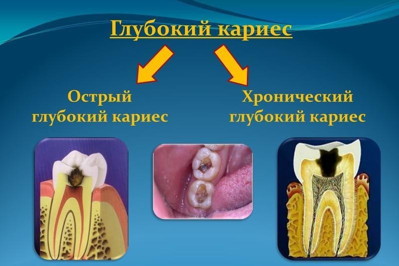 Удаление нерва из зуба
