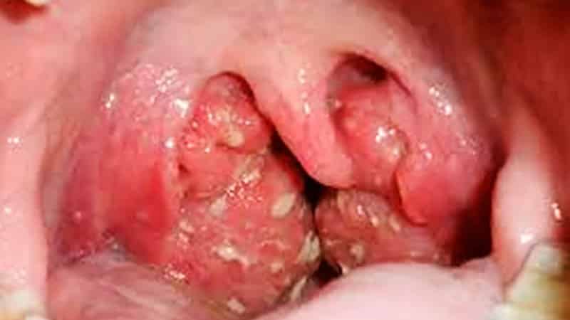 гнойный тонзиллит фото