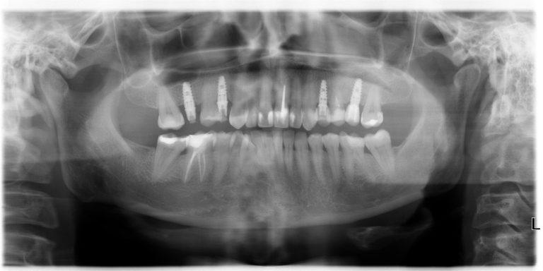 Зубные имплантаты Астра Тек и высокая квалификация наших врачей – ваша идеальная улыбка на долгие годы