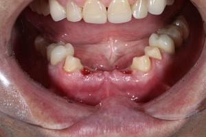 Зубные имплантаты Астра Тек и высокая квалификация наших врачей – ваша идеальная улыбка на долгие годы