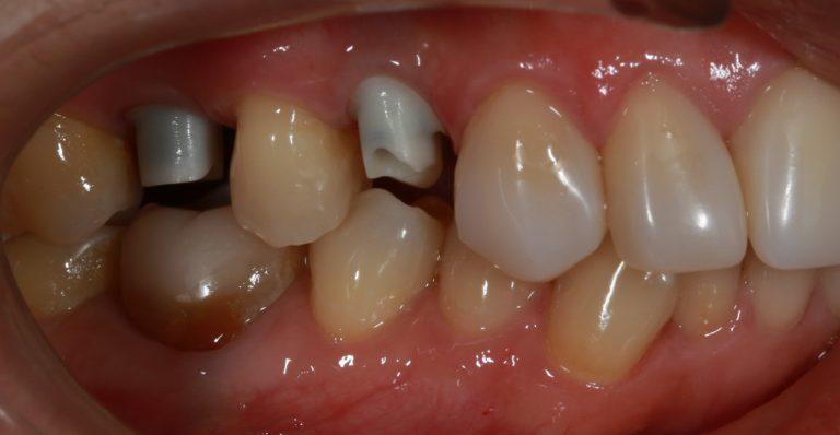 Зубные имплантаты Астра Тек и высокая квалификация наших врачей – ваша идеальная улыбка на долгие годы