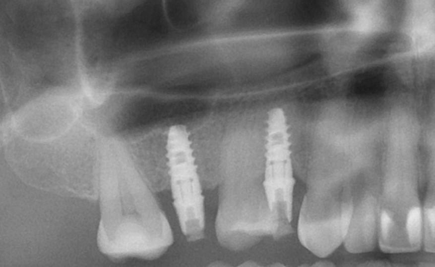 Зубные имплантаты Астра Тек и высокая квалификация наших врачей – ваша идеальная улыбка на долгие годы