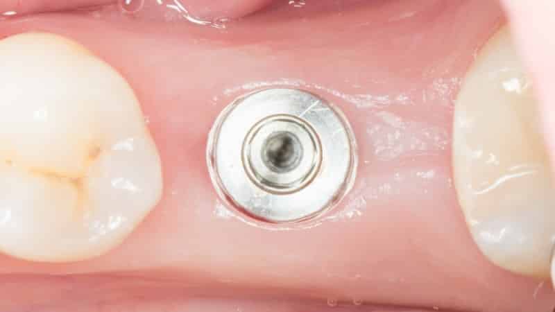 имплантация зубов за один день