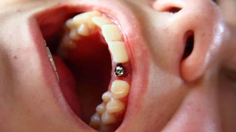 имплантация зуба за один день