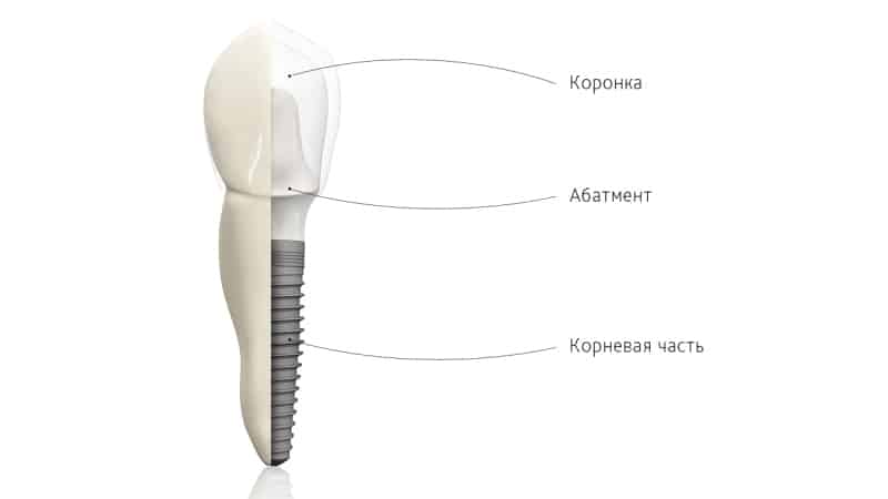 имплантанты зубов