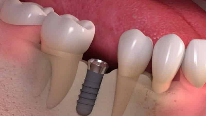 зубная имплантация