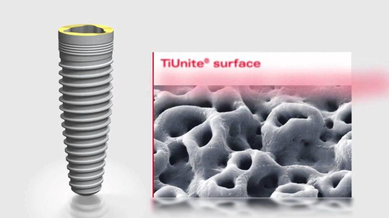 Какие существуют виды имплантатов Nobel Biocare и в чем их преимущества