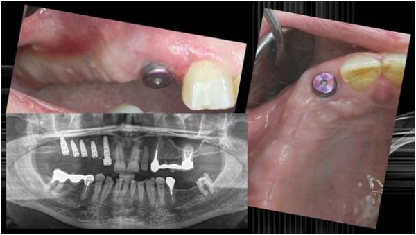 Какие существуют виды имплантатов Nobel Biocare и в чем их преимущества