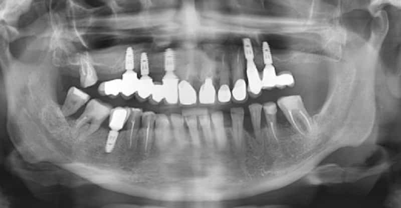 как ставят импланты зубов