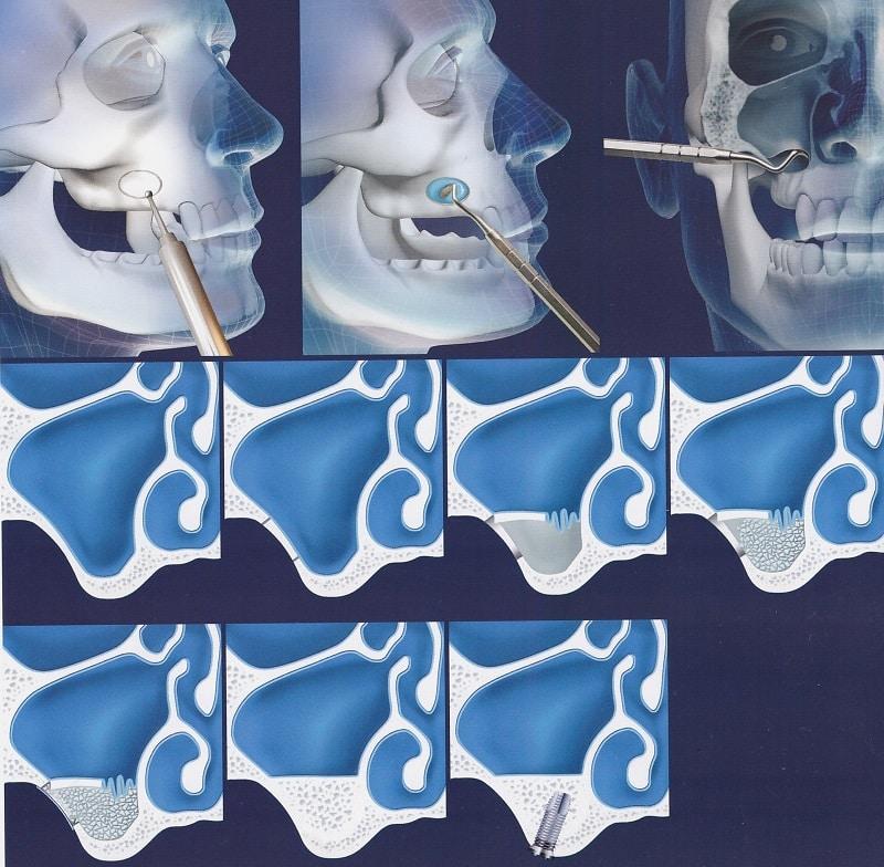 как ставят импланты зубов