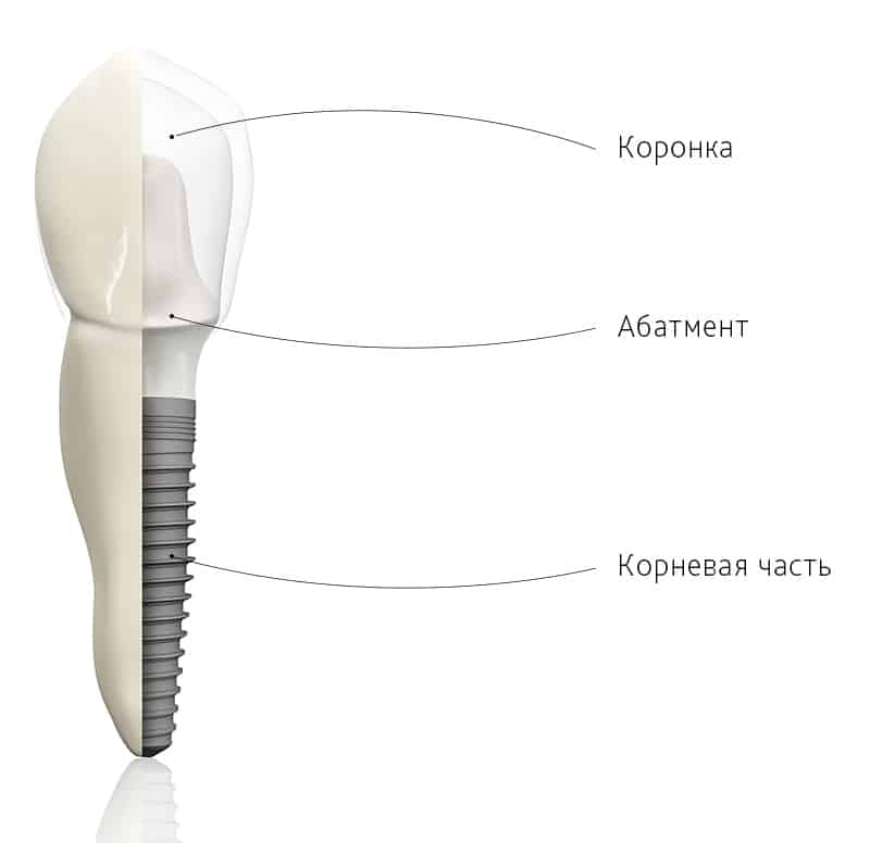 имплантация зубов фото до и после