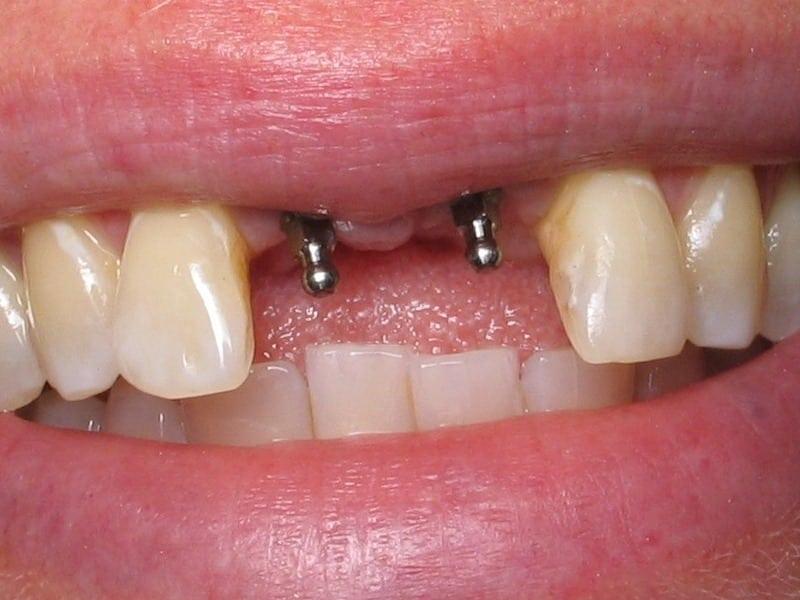 имплантация зубов что это такое фото