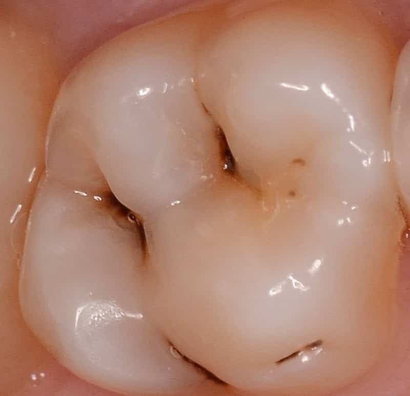 Зубные импланты: фото до и после