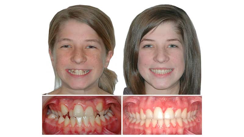 Исправление прикуса