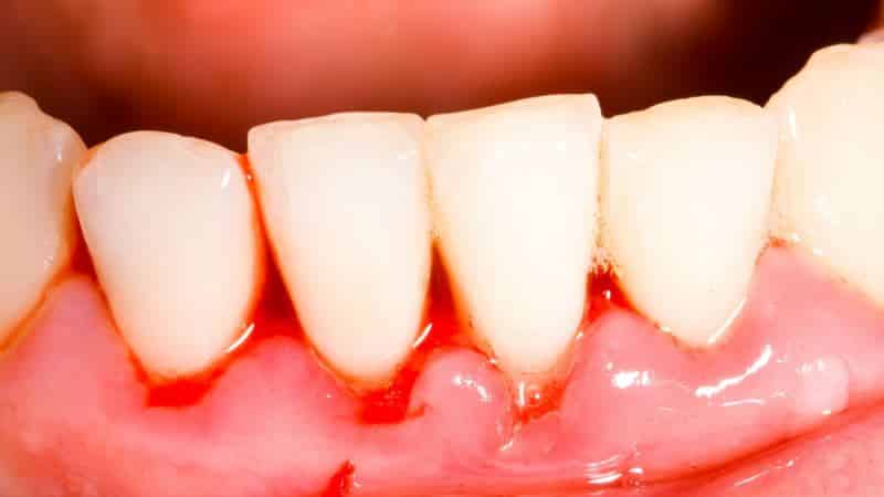 кровь изо рта по утрам причины