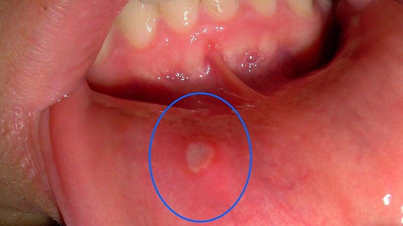 Язвочка под языком что это