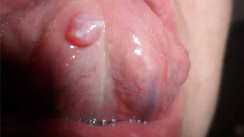 Болячка под языком