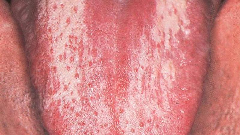 Под языком белая болячка лечение