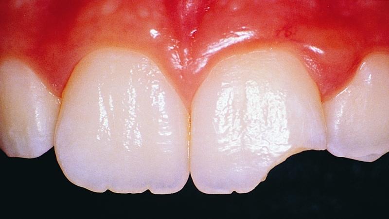 к чему ломаются зубы во сне