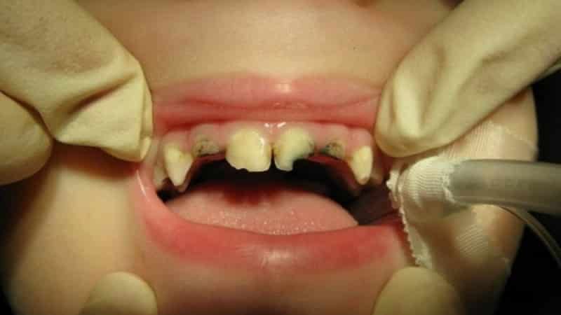 к чему снятся зубы выпадают и крошатся