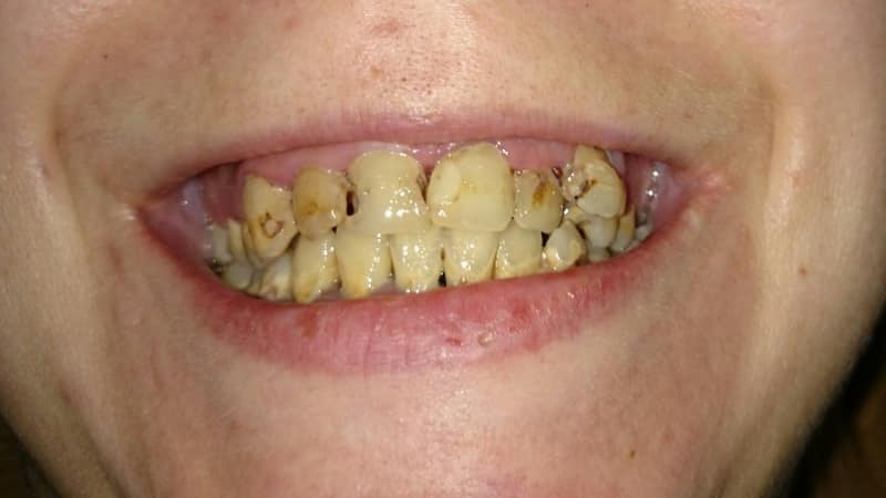 к чему во сне крошатся зубы