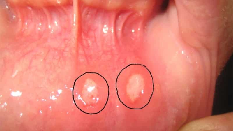 как быстро избавиться от стоматита во рту
