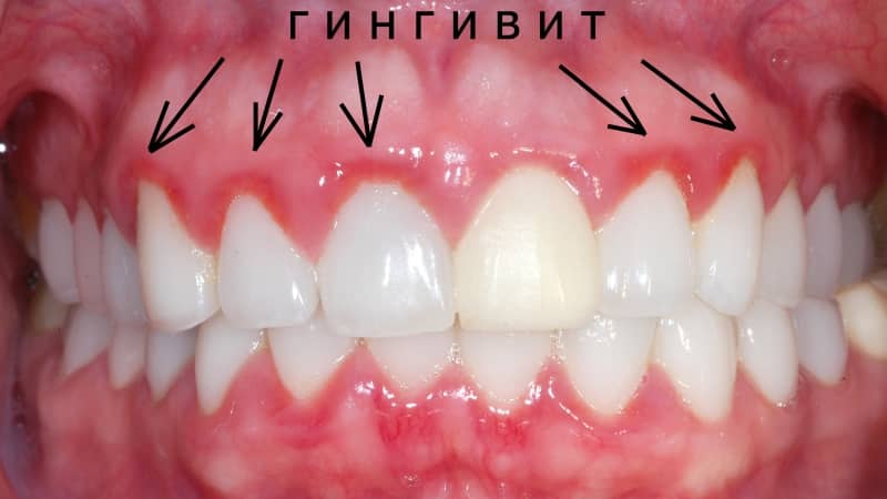 сколько раз в год нужно менять зубную щетку