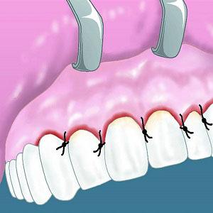 Как делают лоскутную операцию десен
