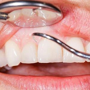 Как делают лоскутную операцию десен