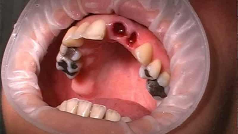 сколько заживает десна после удаления коренного зуба