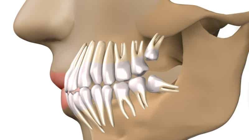 как болит зуб мудрости симптомы признаки роста