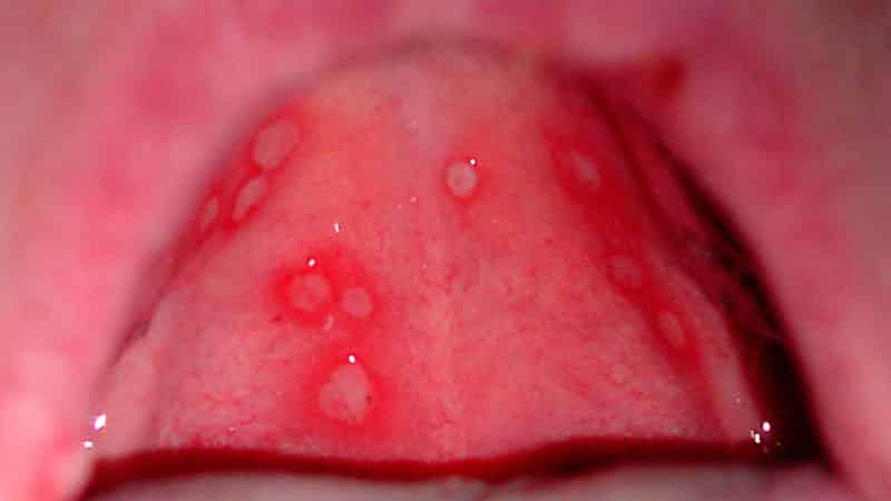 Как лечить болячку на языке