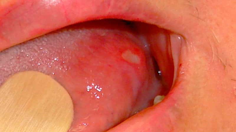 Как лечить болячку на языке