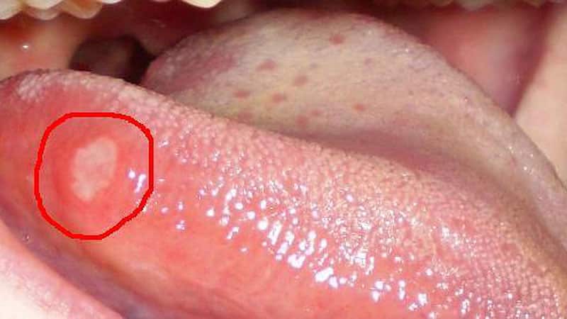 Как лечить болячку на языке
